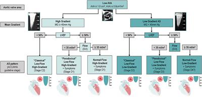 Multimodality Imaging for Discordant Low-Gradient Aortic Stenosis: Assessing the Valve and the Myocardium